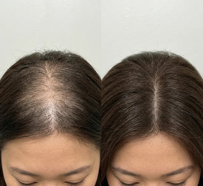 Patient after PRP therapy and low-level laser therapy at Nexus Clinic — improved hair density and reduced scalp visibility