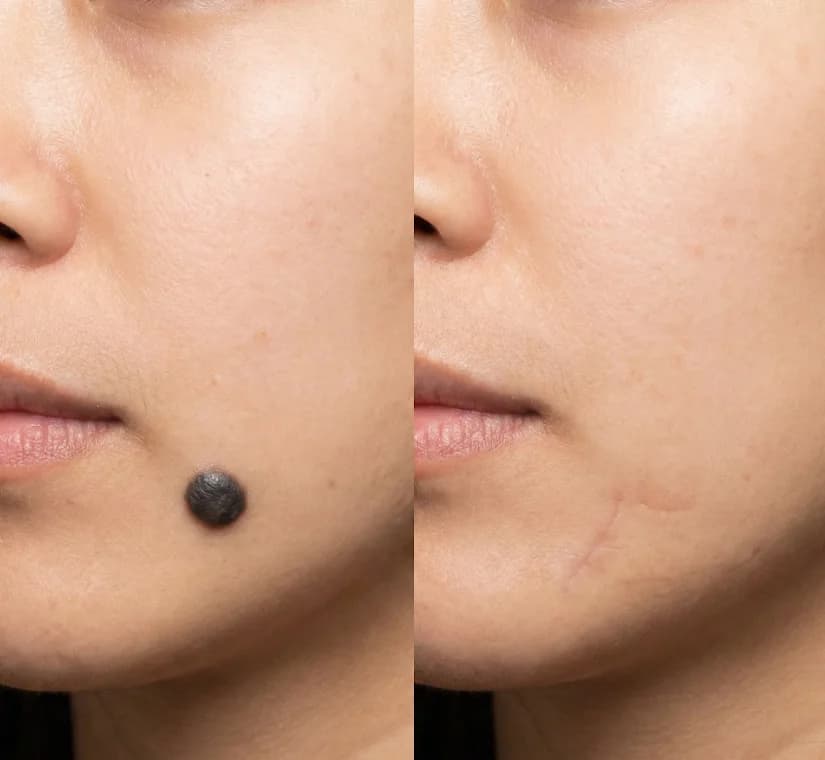 Patient after 3 sessions of Q-Switch ND:YAG laser at Nexus Clinic — significant reduction in freckles with even skin tone