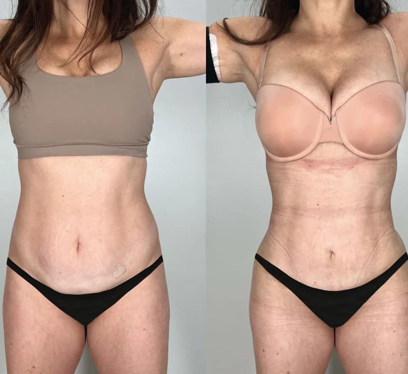 Patient after CoolSculpting Elite at Nexus Clinic — well-defined jawline and balanced chin projection