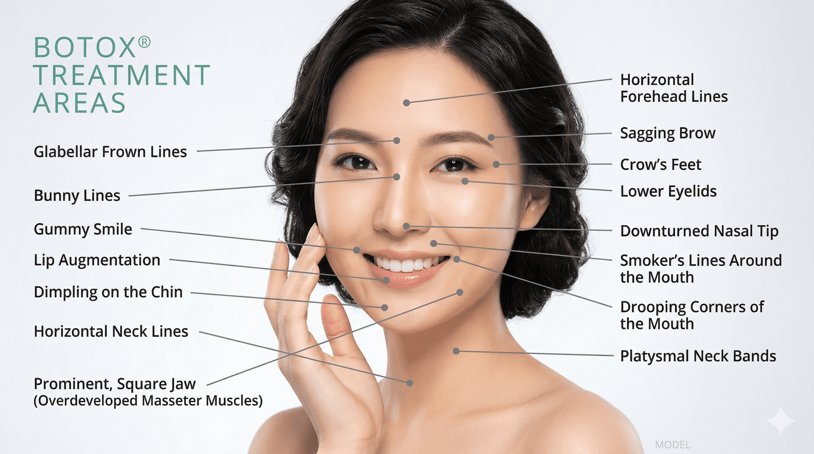Botox Treatment Areas Diagram