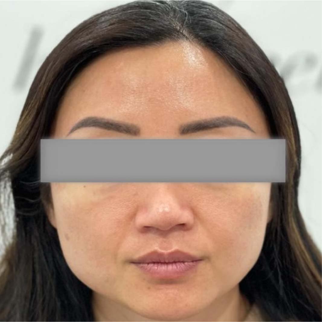 THREADLIFT AFTER 3 MONTHS AND CELEBRITIES IN THREADLIFT