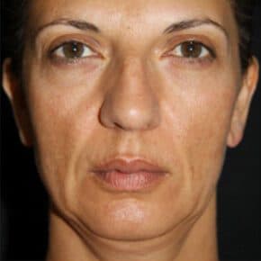 The Benefits of Hydrogen Antioxidant Therapy for Anti-Aging in Malaysia