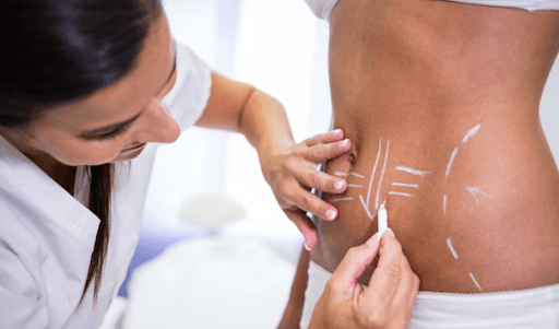 CoolSculpting 2026: What’s New in Non-Surgical Fat Removal Treatments