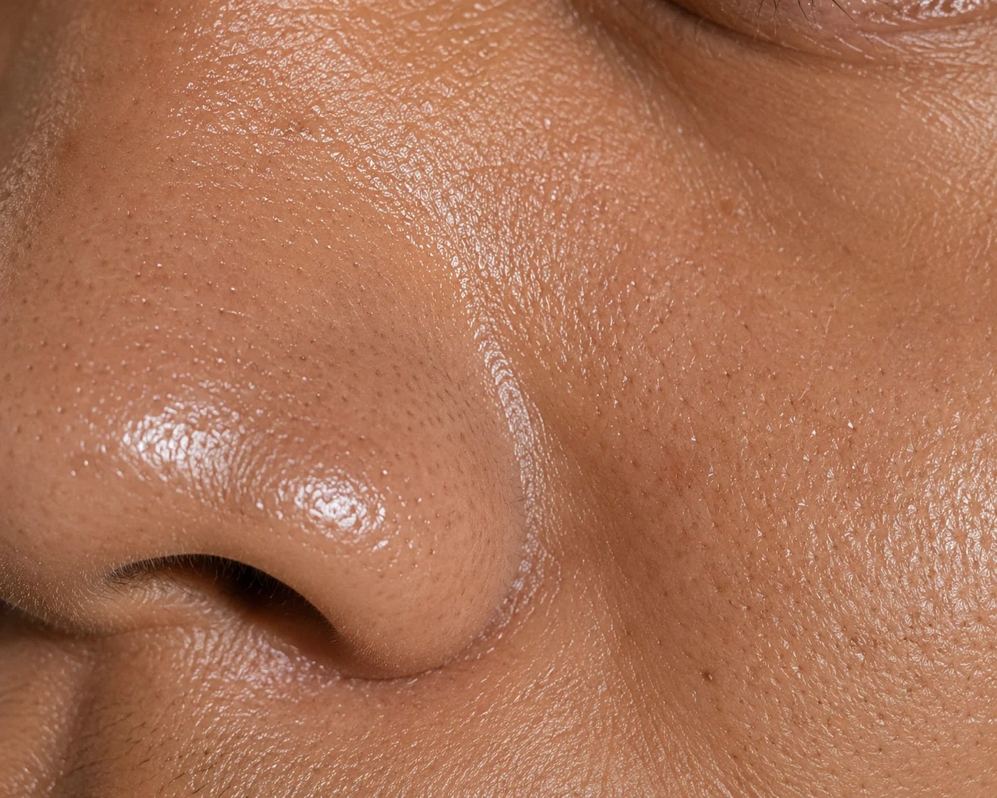 Enlarged pores and skin texture on cheek. Pico Laser pore tightening at Nexus Clinic KL