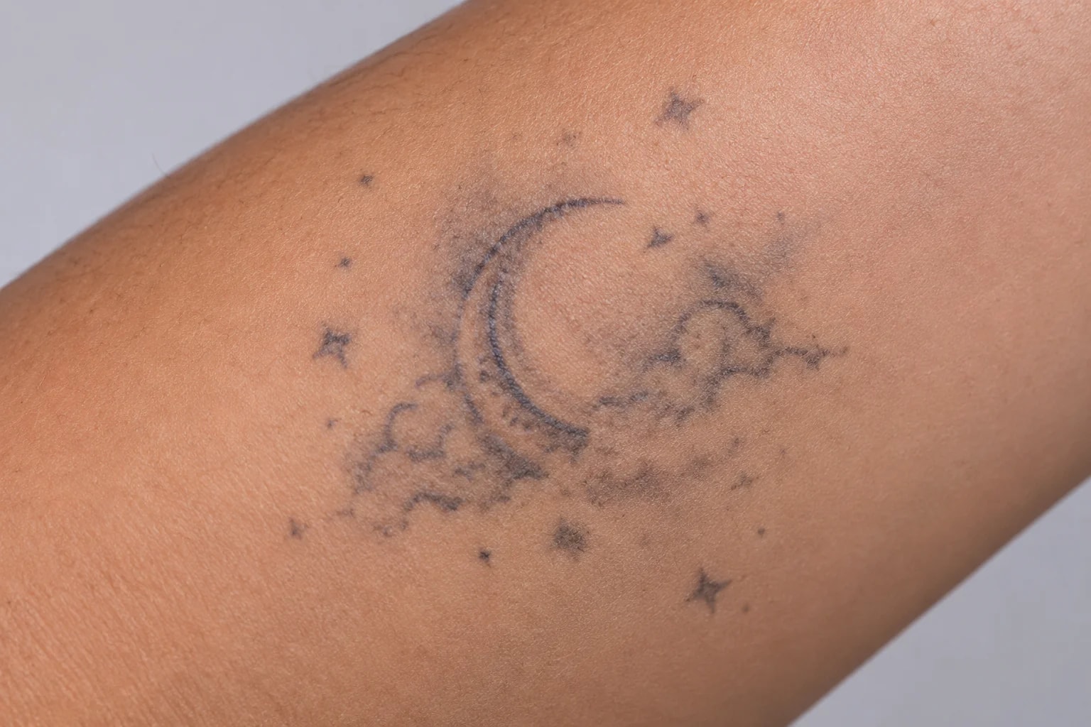 Tattoo being treated with picosecond laser. Pico Laser tattoo removal at Nexus Clinic KL