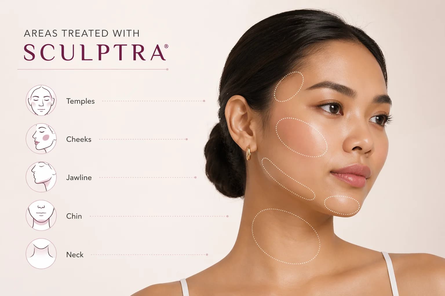 Sculptra collagen-stimulating treatment