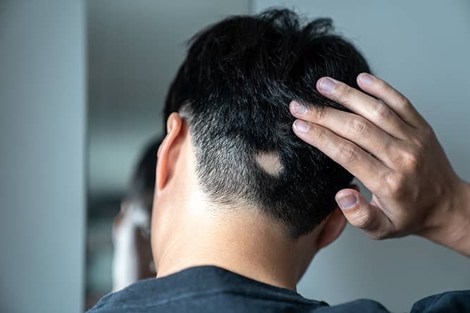 Alopecia areata treatment at Nexus Clinic Kuala Lumpur showing scalp assessment and patchy hair loss