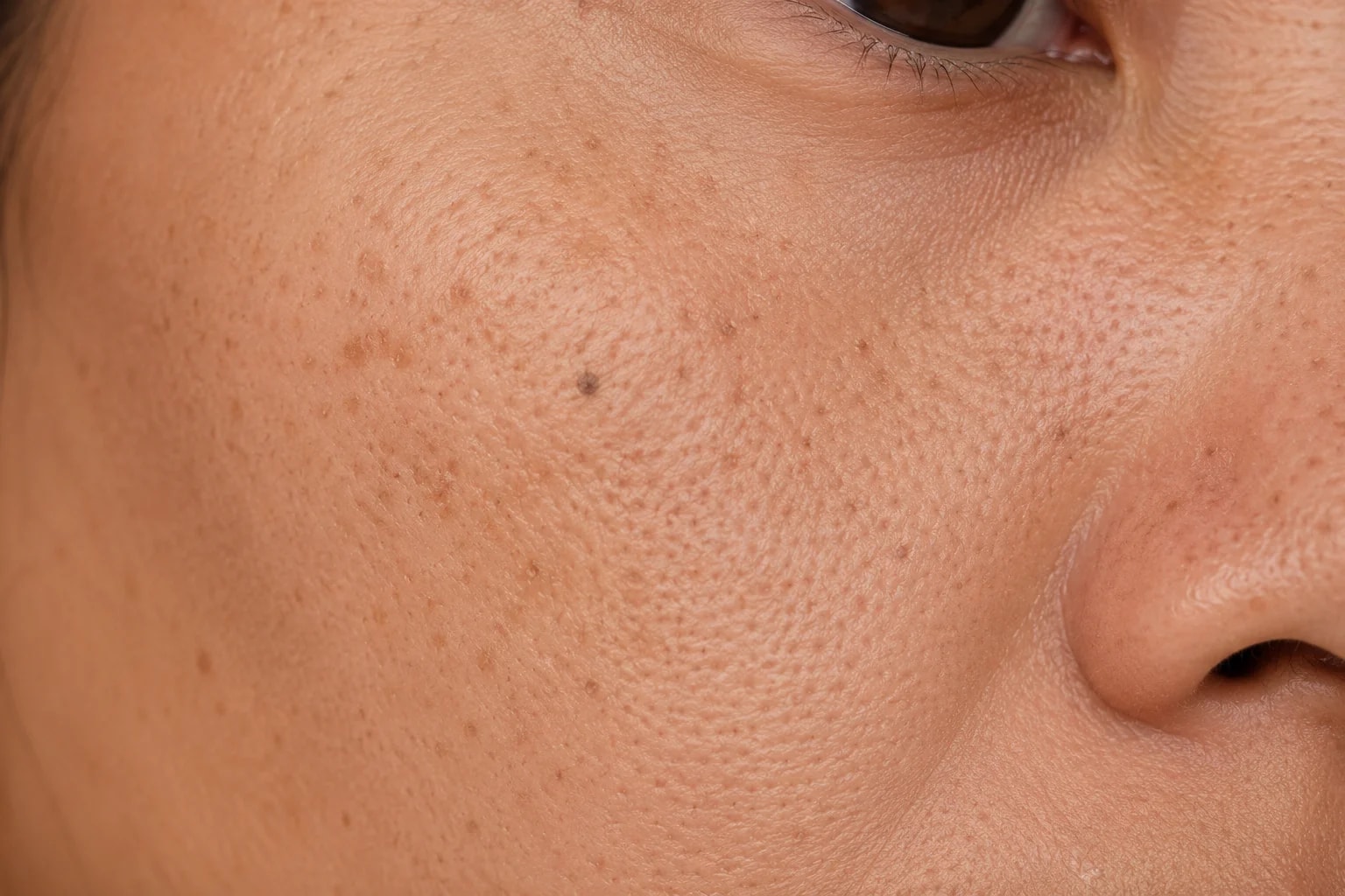 Freckles and jeragat across cheeks and nose. Pico Laser freckle removal at Nexus Clinic KL