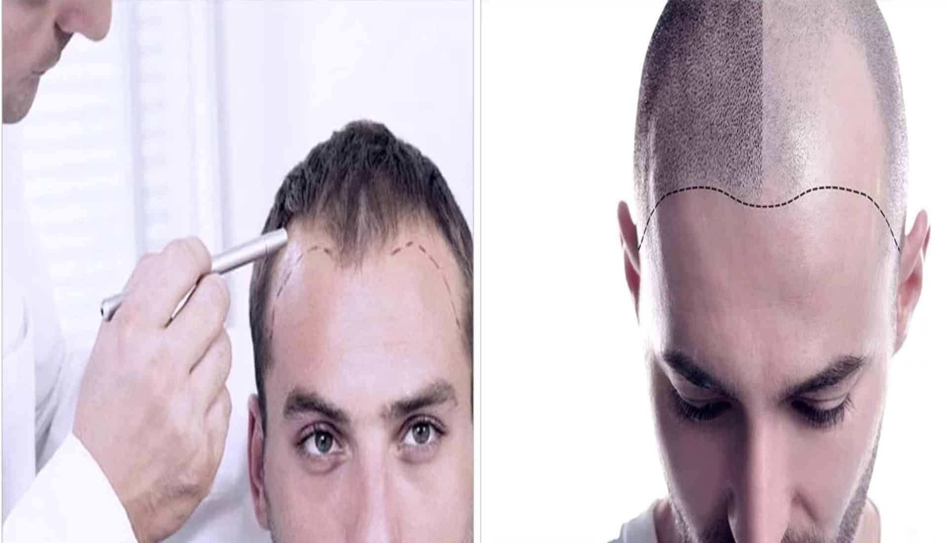 Hair Transplant in Kuala Lumpur: A Complete and Comprehensive Guide