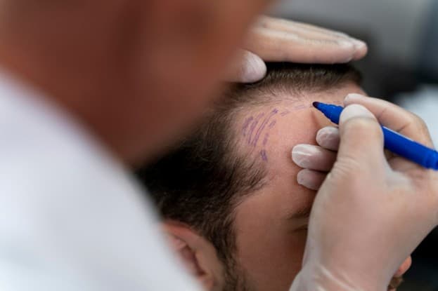 Scalp Micropigmentation in KL: A Permanent Solution for Hair LossScalp Micropigmentation in KL: A Permanent Solution for Hair Loss