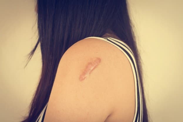 Effective Scar Treatment Clinics in Malaysia: What to Expect