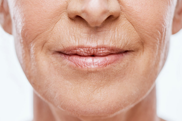Fine-Lines-Around-the-Mouth
