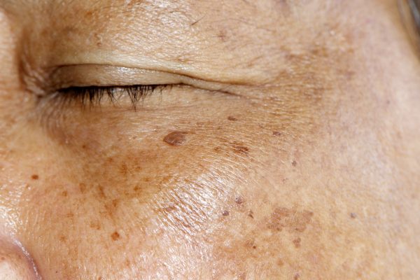 hyperpigmentation-treatment