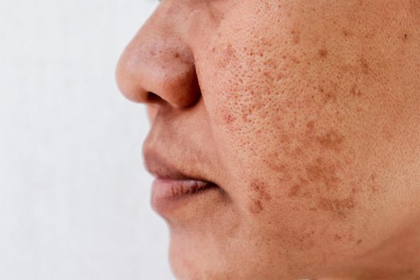 open_pores_IMG-1024x683