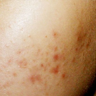 Effective Subcision Treatment