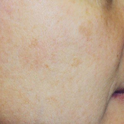 Medlite C6 NdYAG Laser Treatment