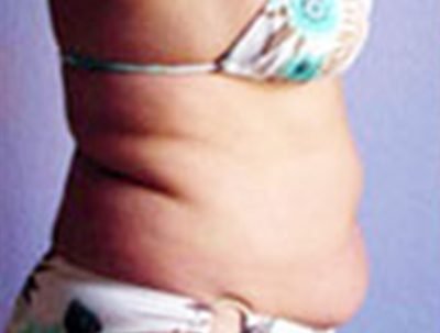 Visible belly fat before