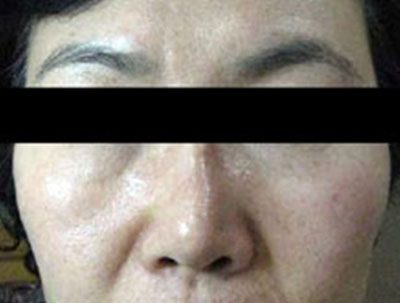 HIFU Treatment for Skin Lifting