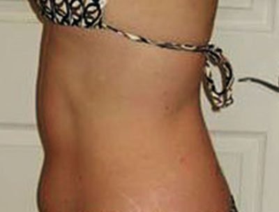 Visible bruise dots before