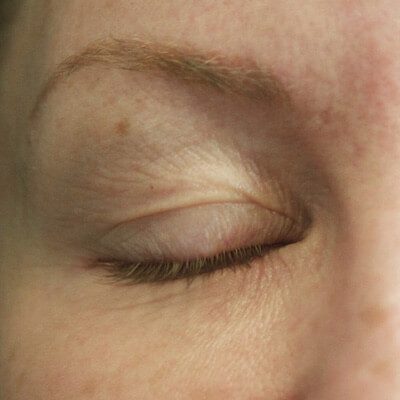 Fractional Laser Resurfacing 