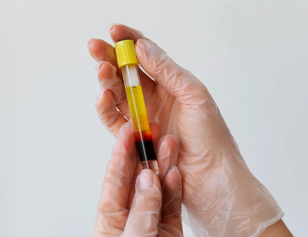 hands holding vial prp treatments close up copy
