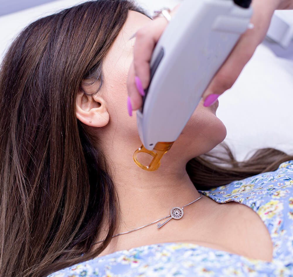 laser epilation procedure female neck hairs 1