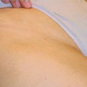 laser tattoo removal after 2