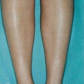 laser tattoo removal after 3