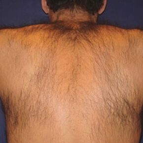 Permanent Laser Hair Removal
