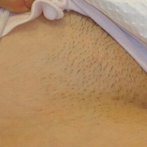 Malaysia Laser Hair Removal