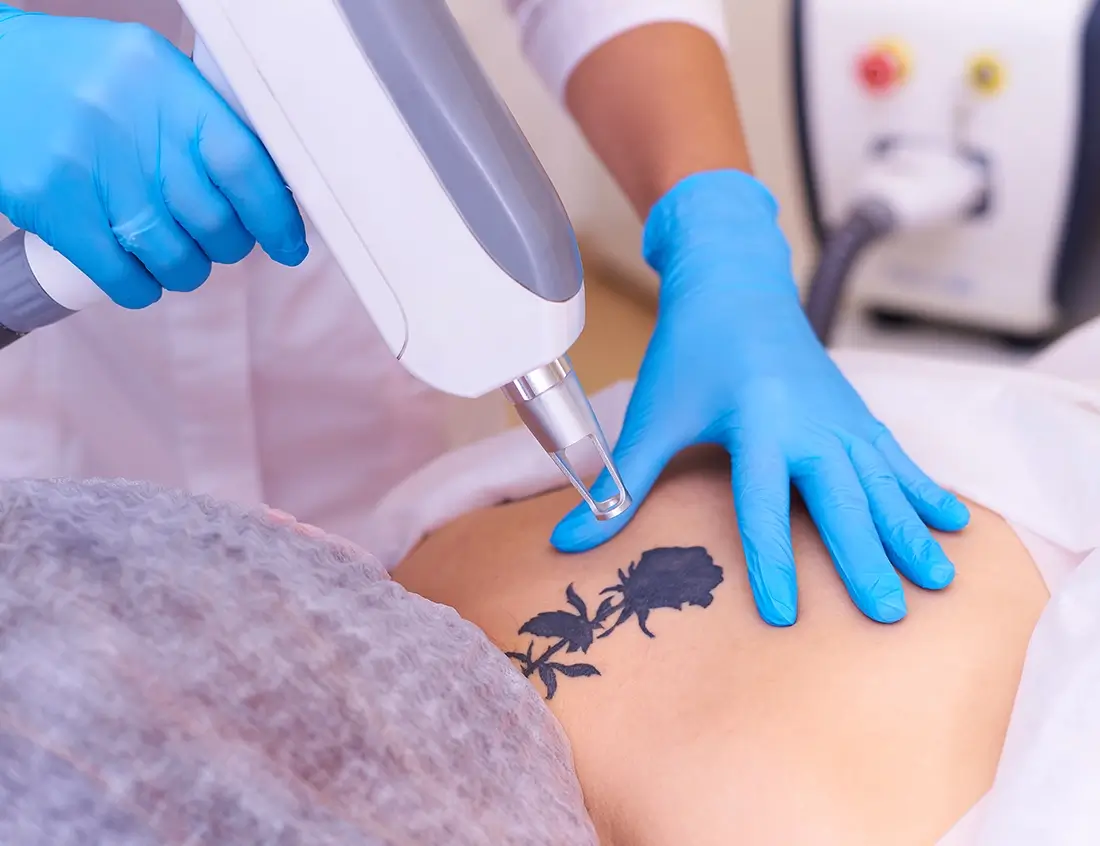 laser tattoo removal cosmetology clinic 1 copy