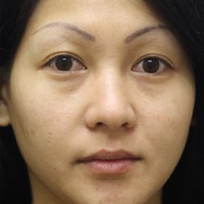 Eye Bag Removal Malaysia