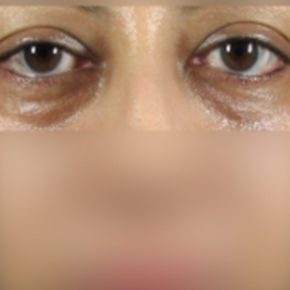 Non-Surgical Eye Bag Removal Malaysia