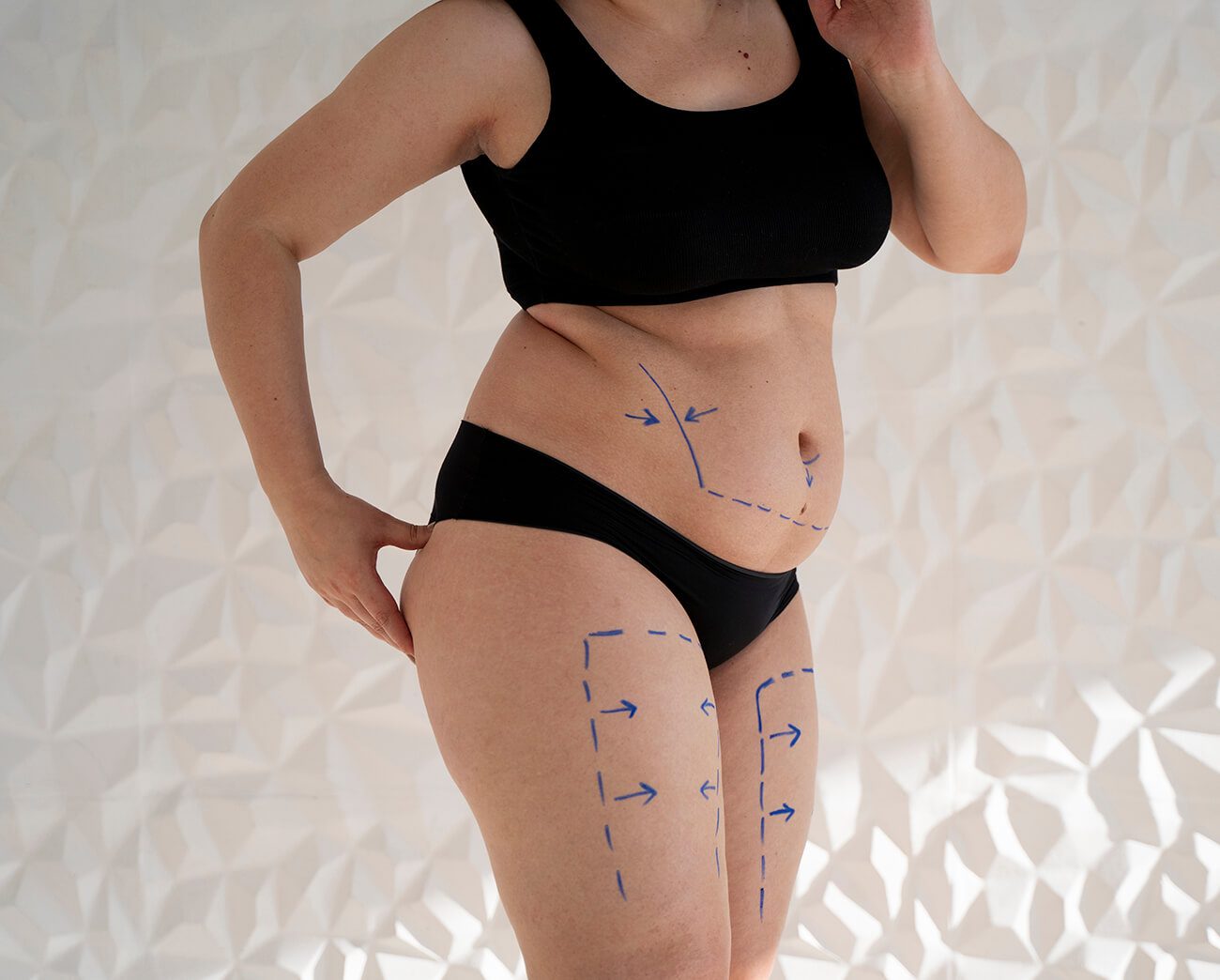 Venus Freeze Body Contouring