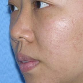 carbon laser peel after 1