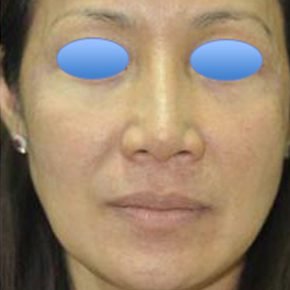 carbon laser peel after 2