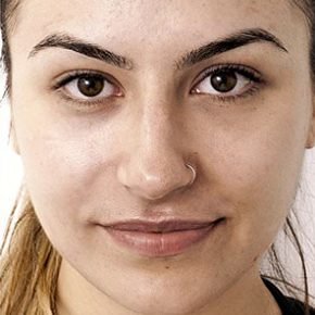 carbon laser peel after 3