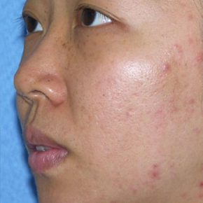 carbon laser peel before 1