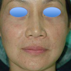 carbon laser peel before 2