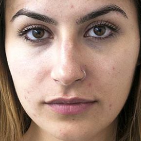 carbon laser peel before 3