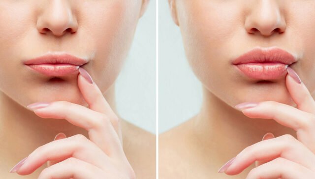 Restylane vs Juvederm