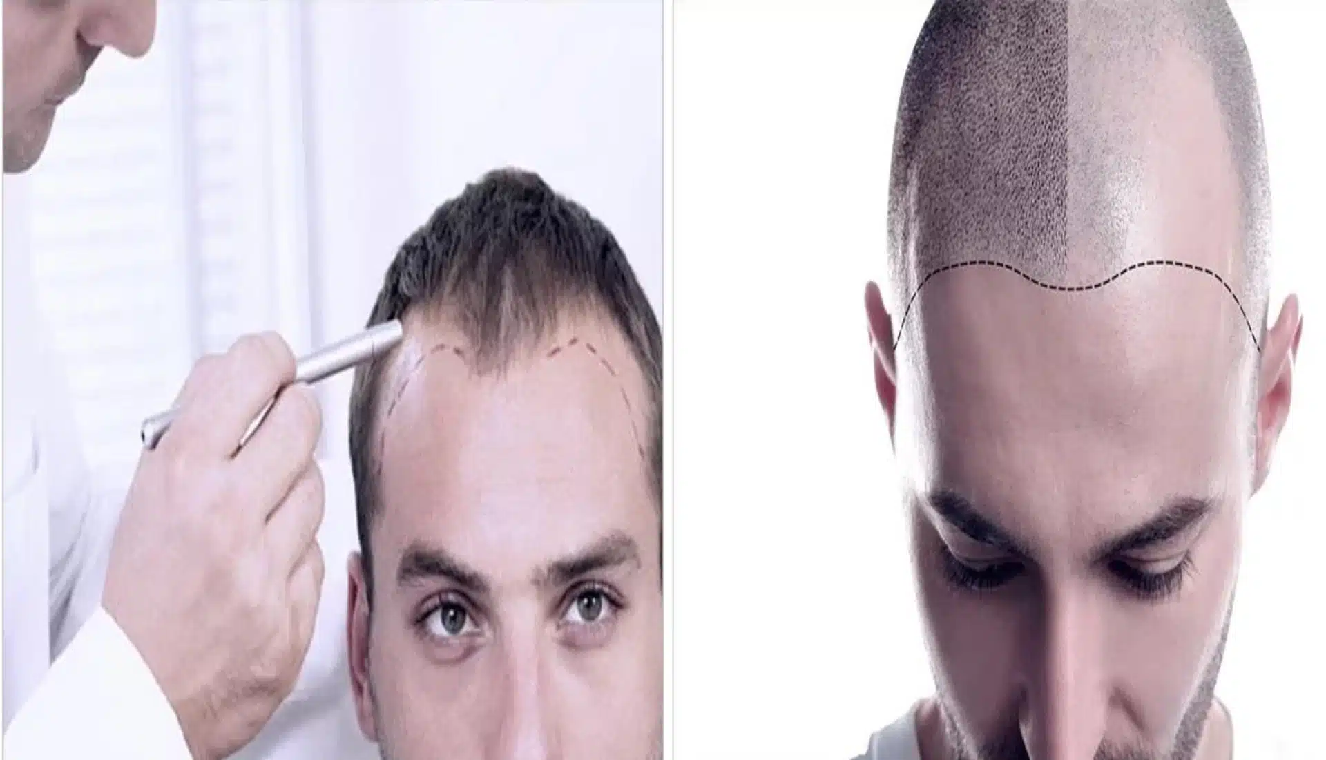 hair transplant 1