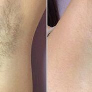 laser-hair-removal-before-after-1 laser-hair-removal-before-after-1