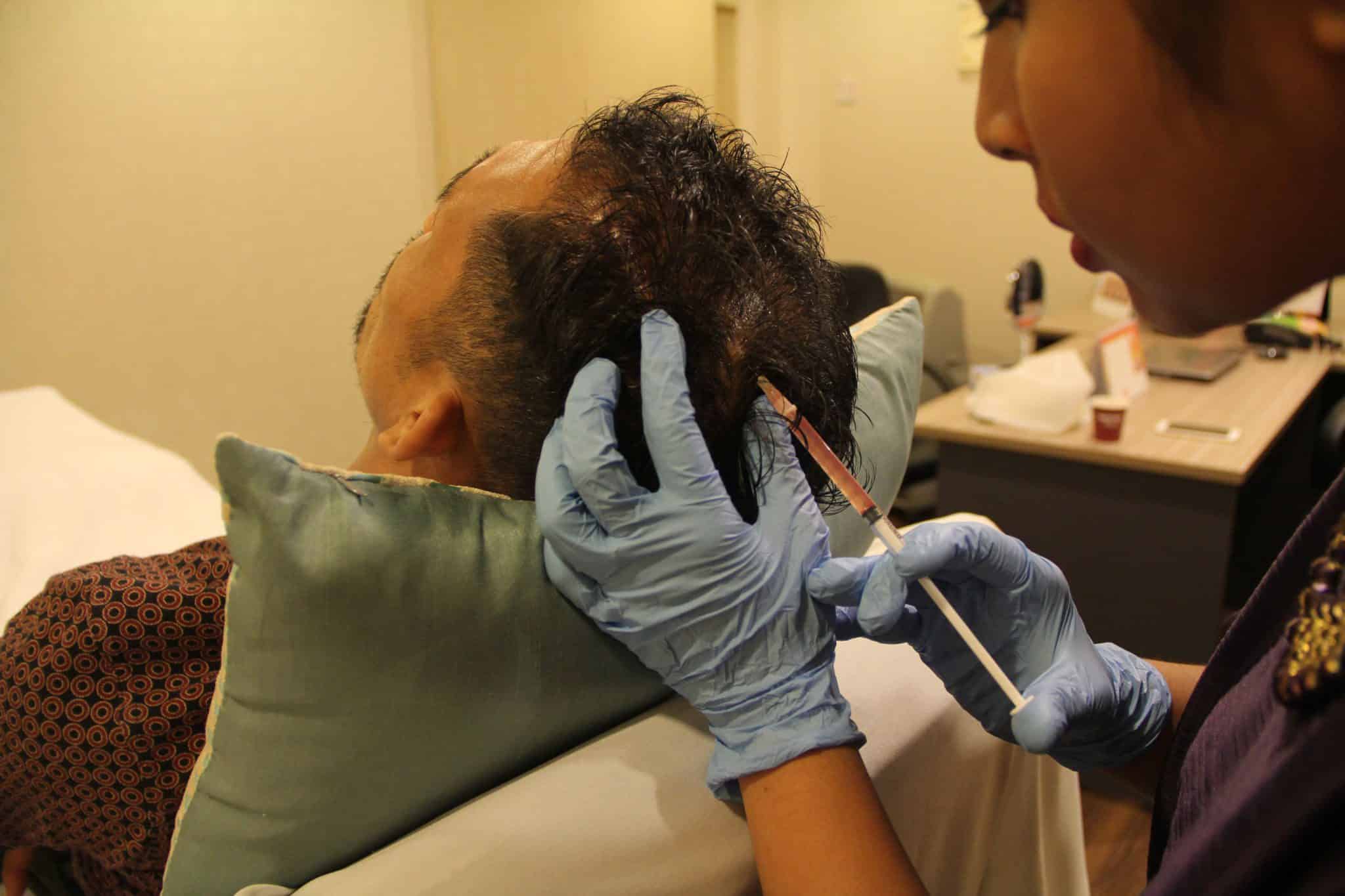 PRP for Hair NonSurgical Treatment of Hair Loss/Balding in Kuala