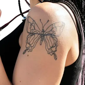 Laser Tattoo Fading Treatment