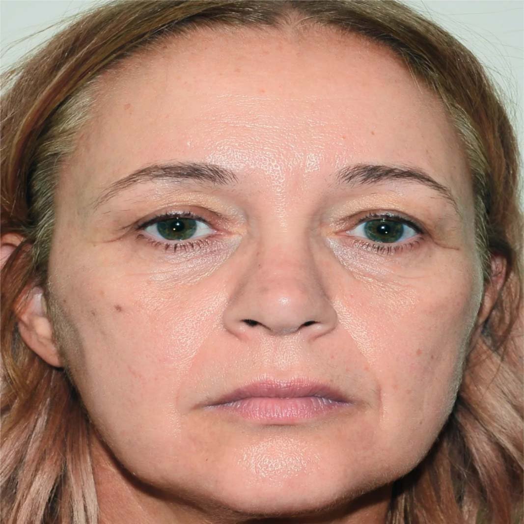 Eyebrow Lift In KL, Malaysia