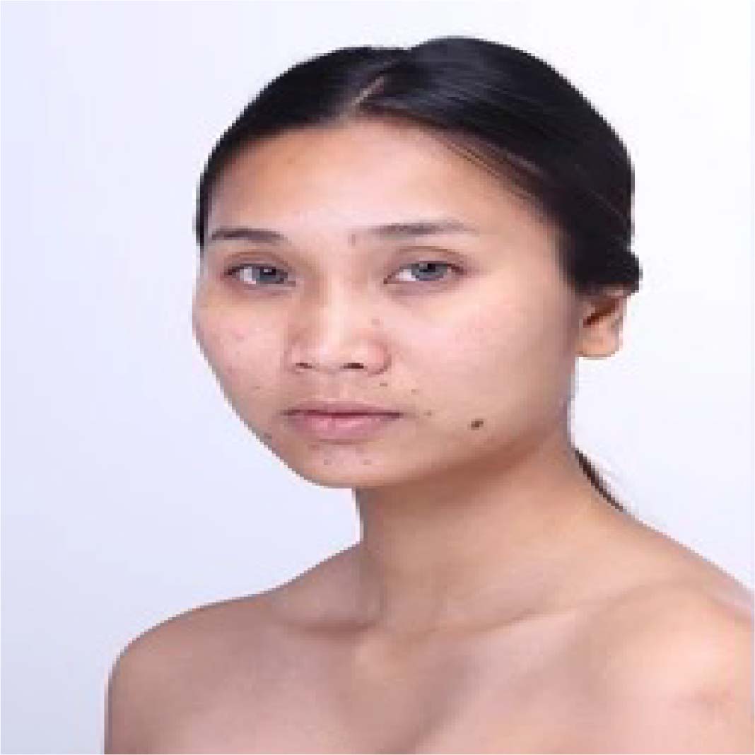 Mesotherapy Brightening Treatment