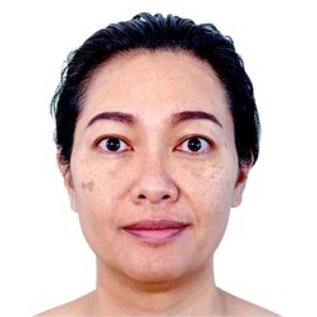 Youthful Glow with Mesotherapy