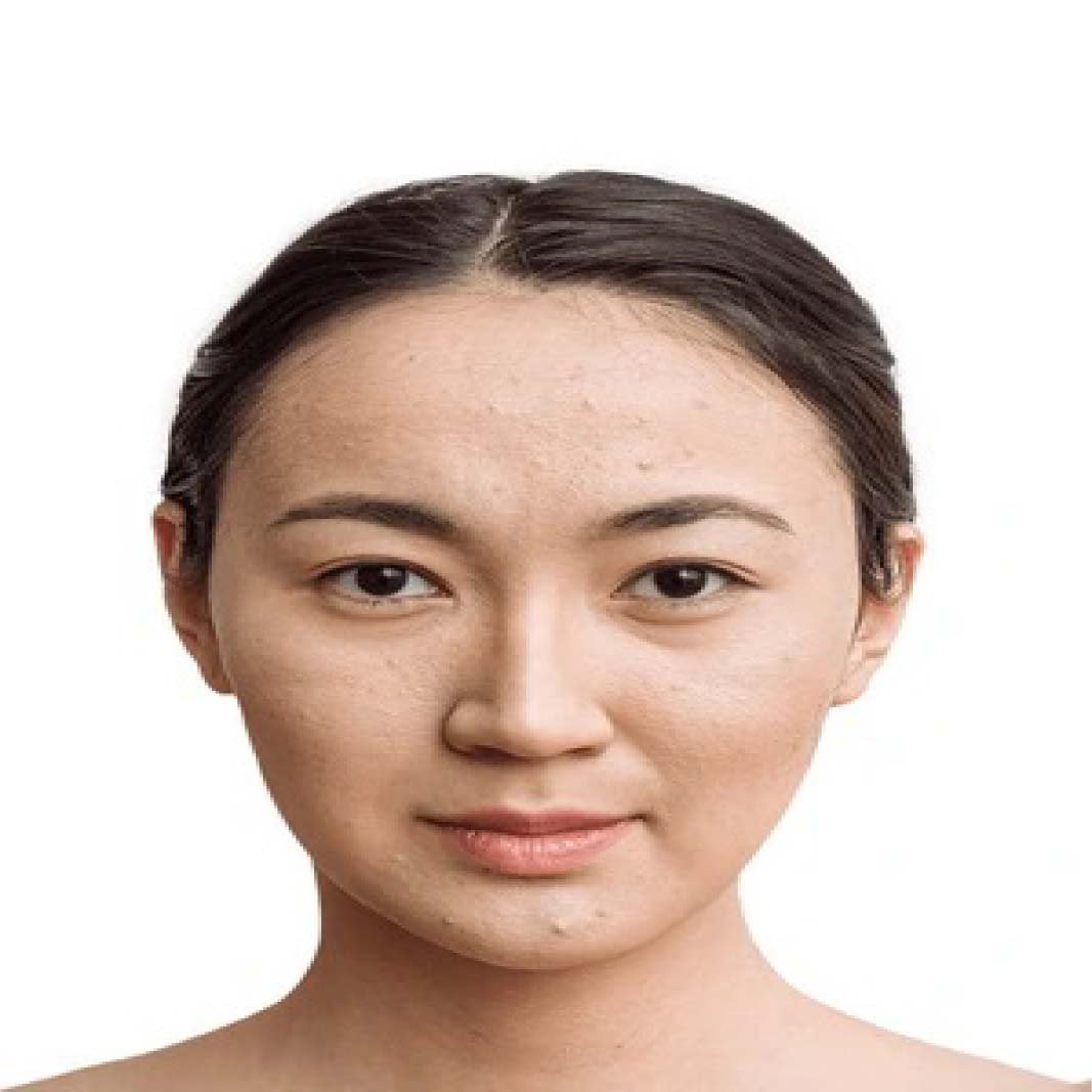 Mesobrightening Skin Treatment Before and After 110