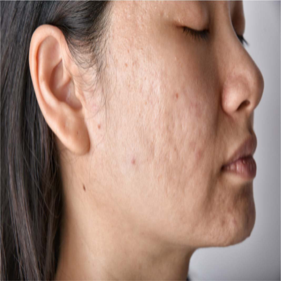Subcision Treatment for Acne Scars 94